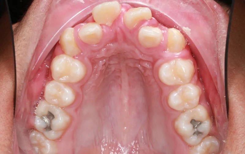 Upper Occlusal - Before Treatment