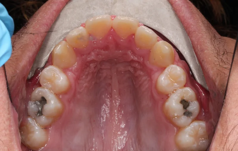 Upper Occlusal - After Treatment