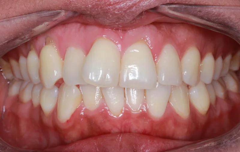 Center Bite - Before Treatment