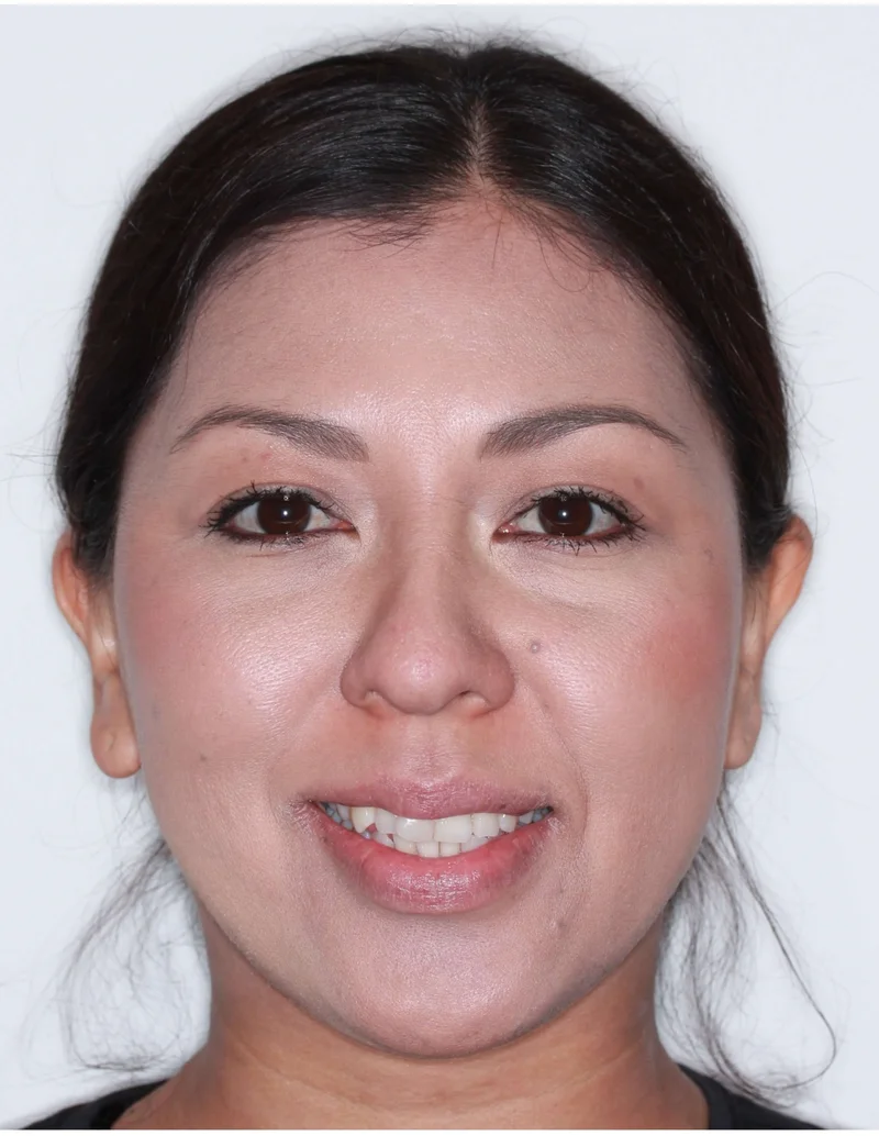 Facial Smiling - Before Treatment