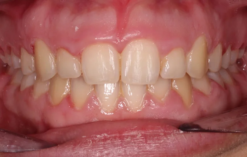 Center Bite - After Treatment