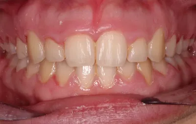 After Metal Braces treatment - Case 78527