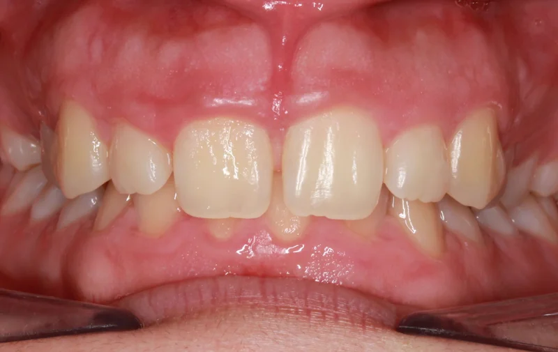 Center Bite - Before Treatment