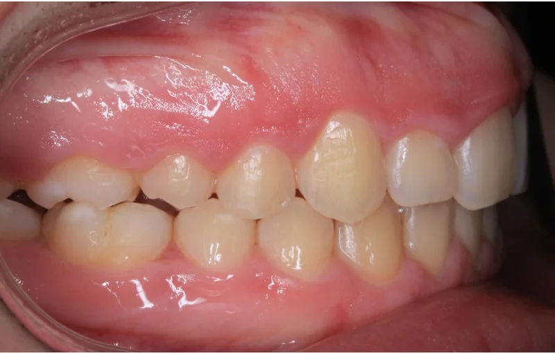 Right Buccal - After Treatment