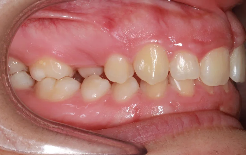 Right Buccal - Before Treatment