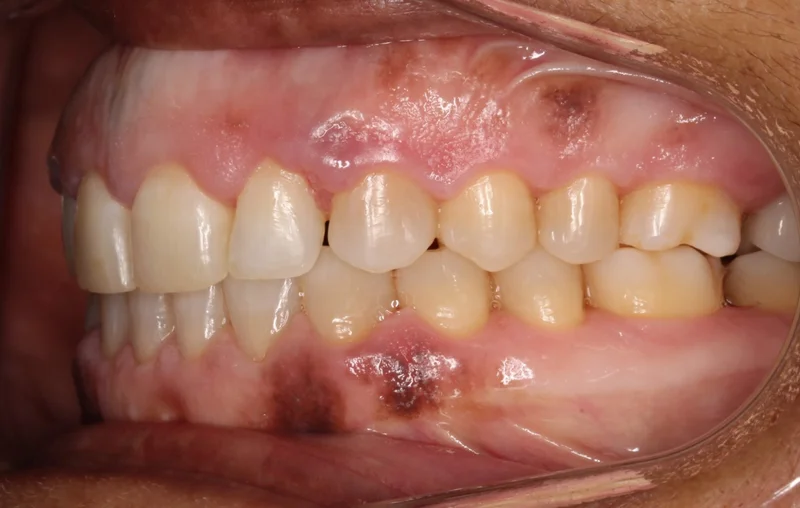Left Buccal - After Treatment