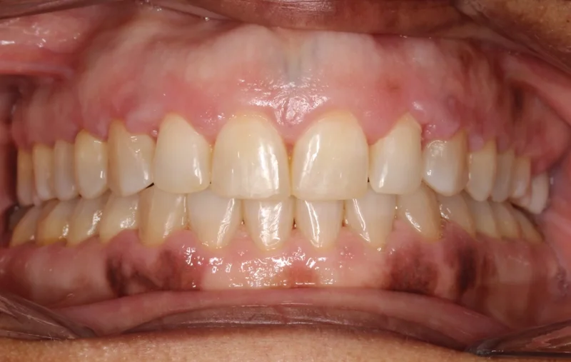 Center Bite - After Treatment