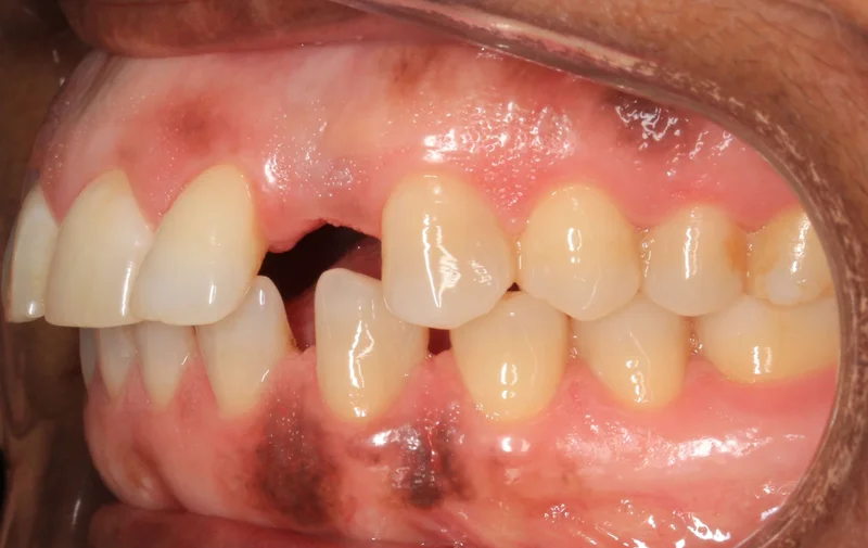 Left Buccal - Before Treatment