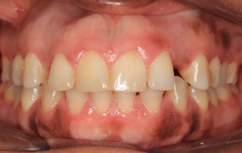Center Bite - Before Treatment