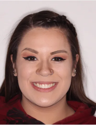 After Metal Braces treatment - Case 54951