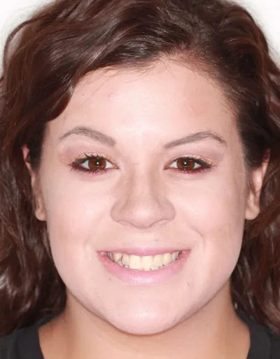 Before Metal Braces treatment - Case 54951