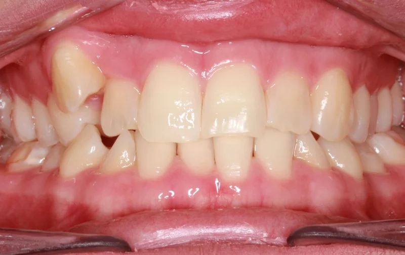 Center Bite - Before Treatment
