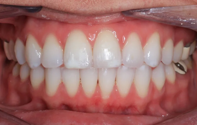 Center Bite - After Treatment