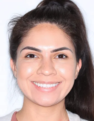 After Clear Aligners treatment - Case 79061