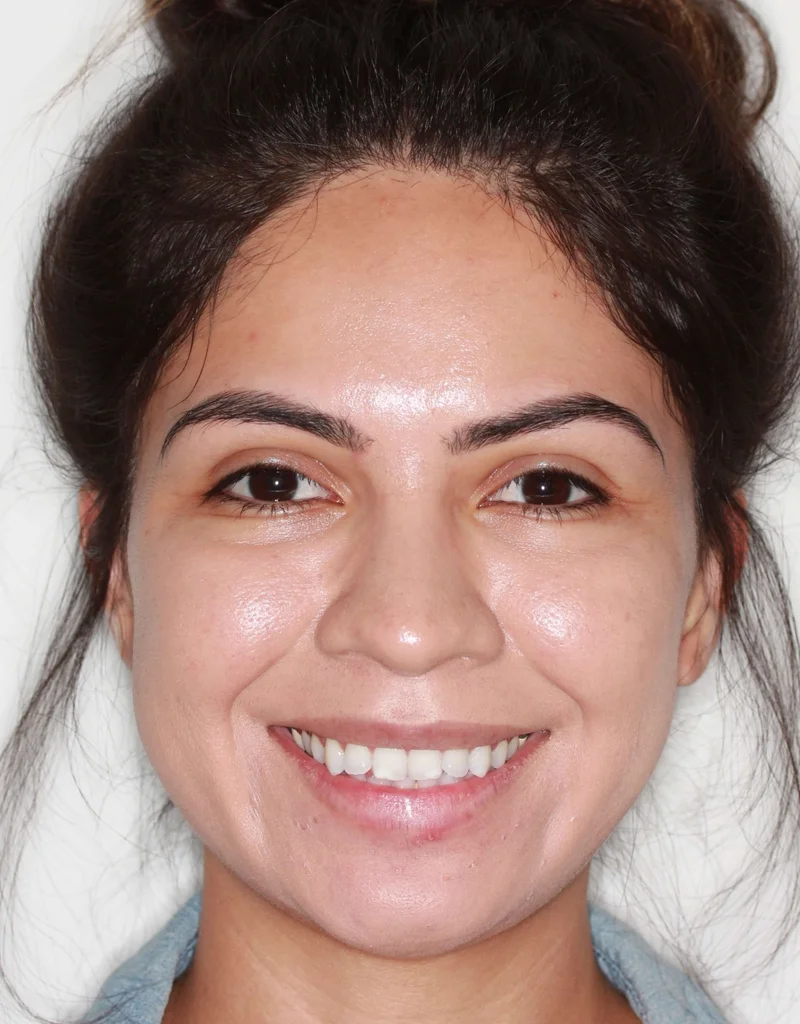 Facial Smiling - Before Treatment