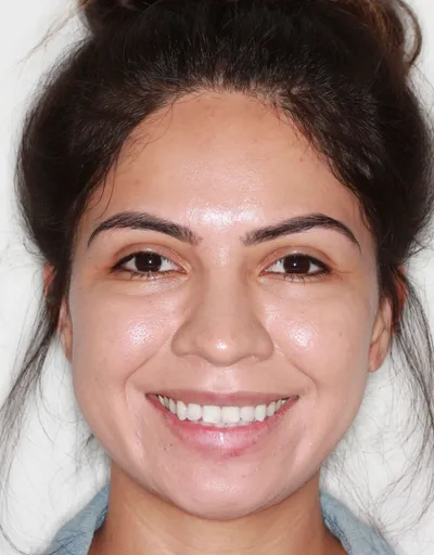 Before Clear Aligners treatment - Case 79061