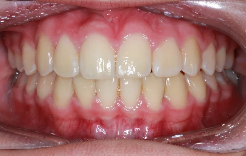 Center Bite - After Treatment