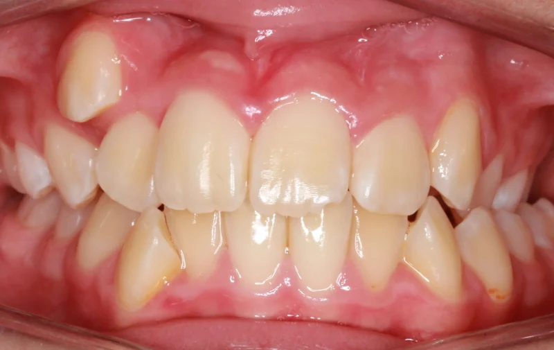 Center Bite - Before Treatment