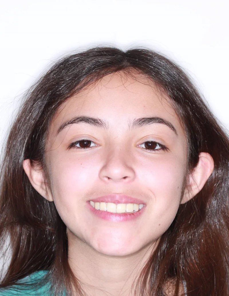 Facial Smiling - After Treatment