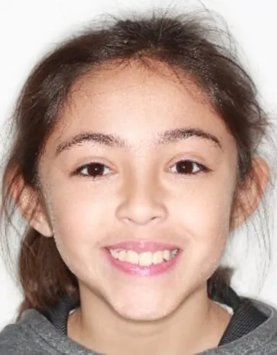 Before Metal Braces treatment - Case 79091