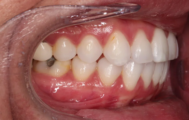 Right Buccal - After Treatment