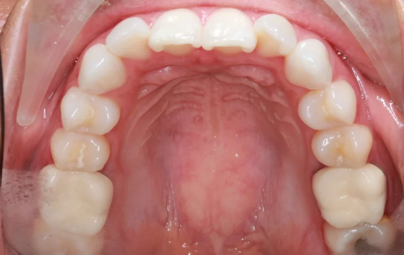 Upper Occlusal - Before Treatment