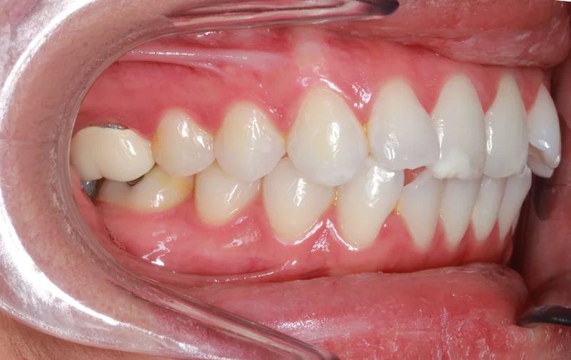 Right Buccal - Before Treatment
