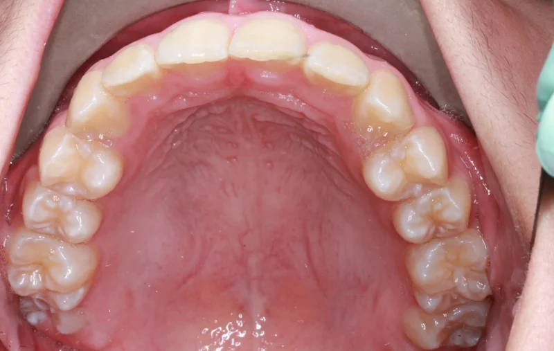 Upper Occlusal - After Treatment