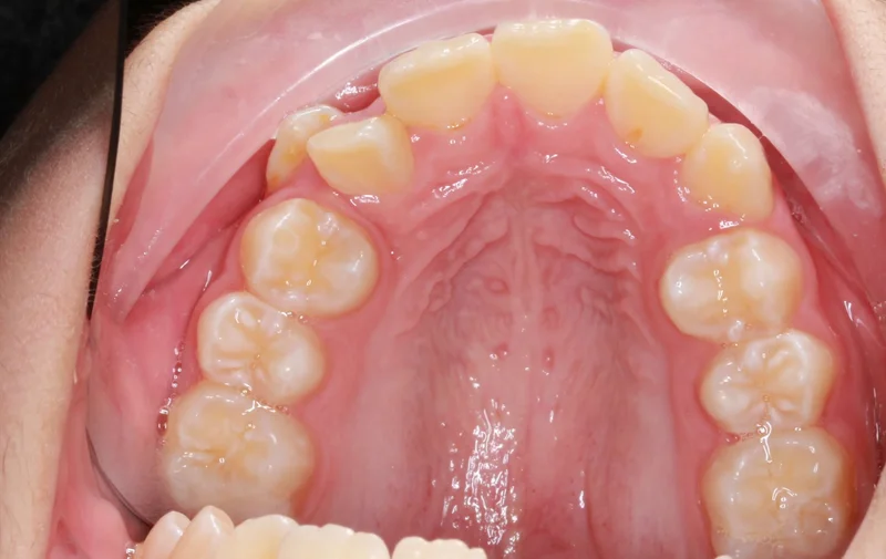 Upper Occlusal - Before Treatment