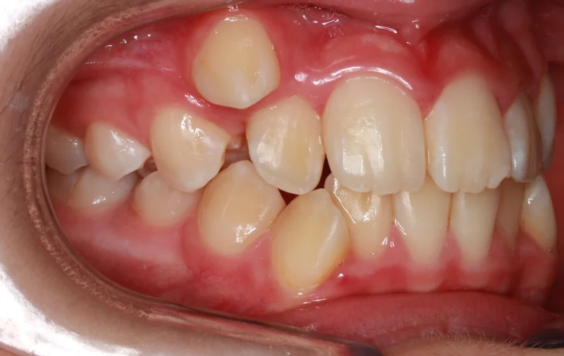 Right Buccal - Before Treatment