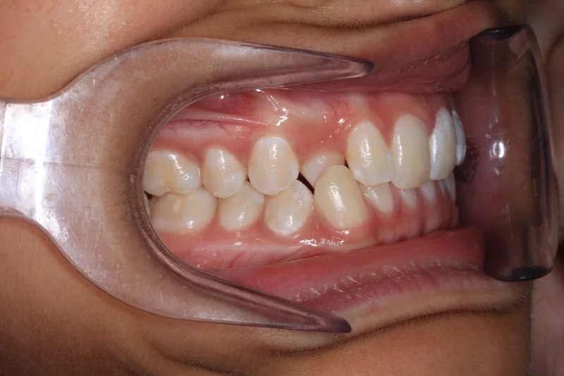 Right Buccal - Before Treatment