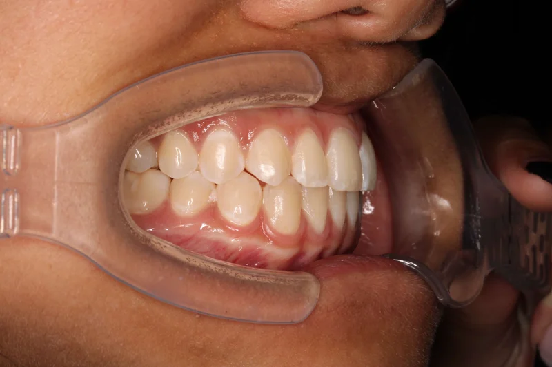 Right Buccal - After Treatment
