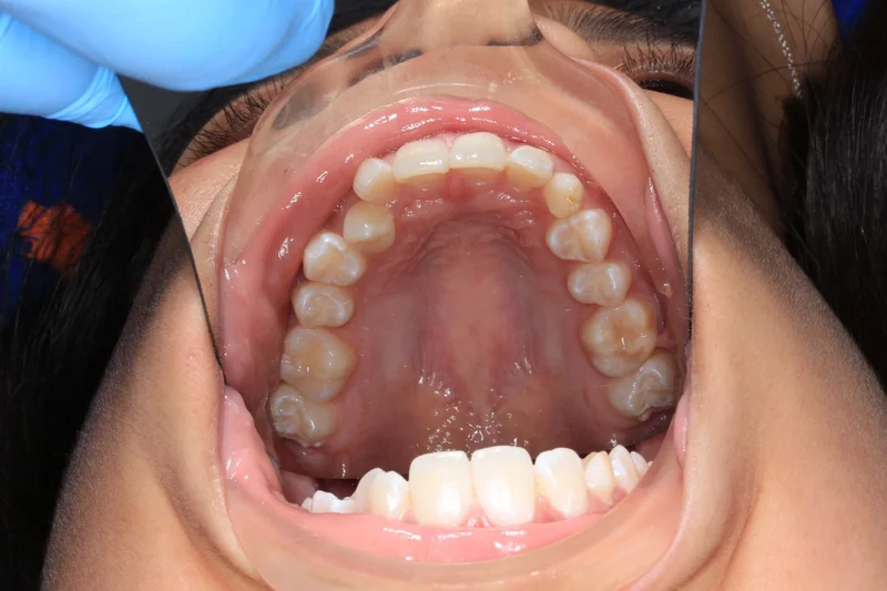 Upper Occlusal - Before Treatment