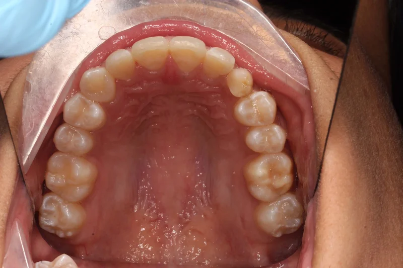Upper Occlusal - After Treatment