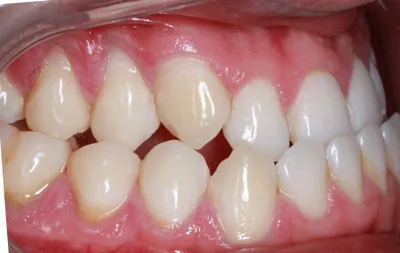 Before Clear Aligners treatment - Case 84703
