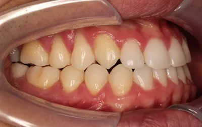 After Clear Aligners treatment - Case 84703