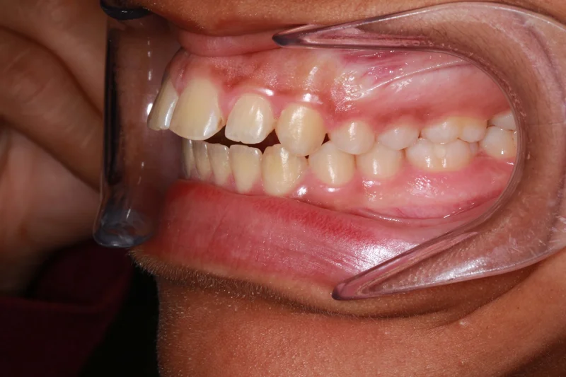 Left Buccal - Before Treatment