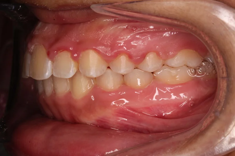 Left Buccal - After Treatment