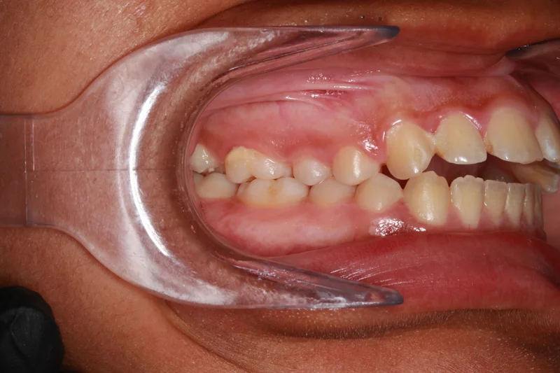 Right Buccal - Before Treatment