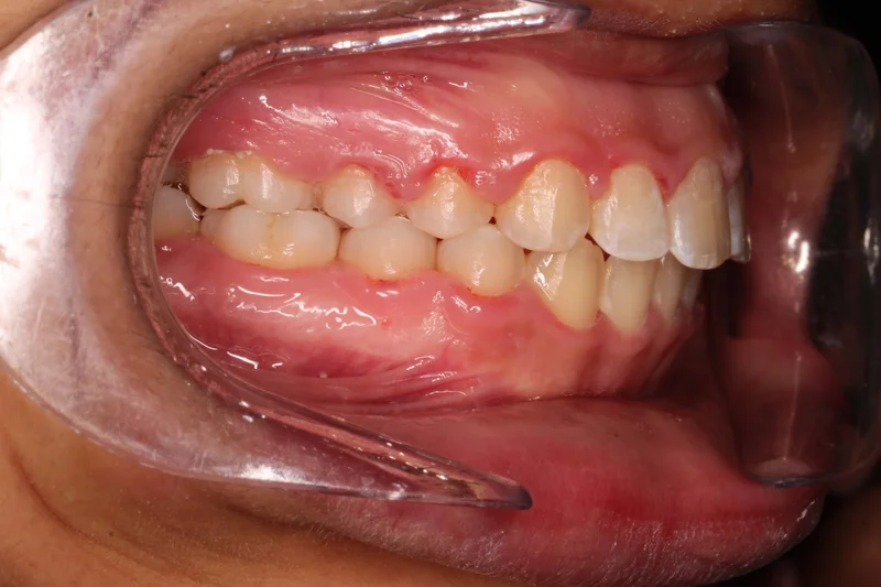Right Buccal - After Treatment