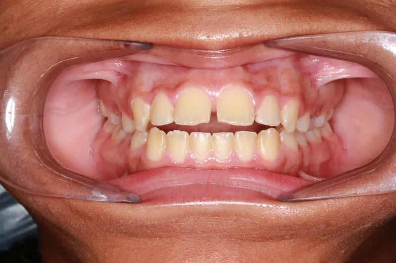 Center Bite - Before Treatment