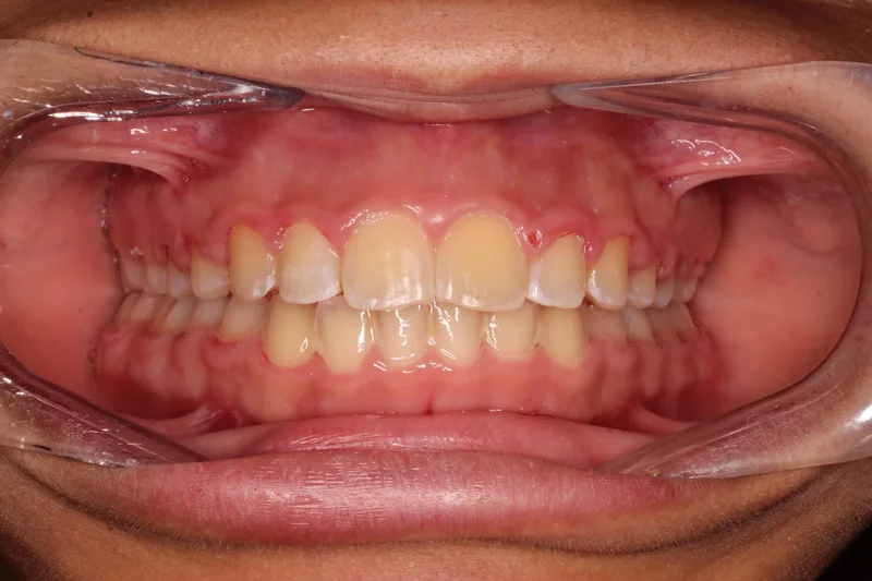 Center Bite - After Treatment