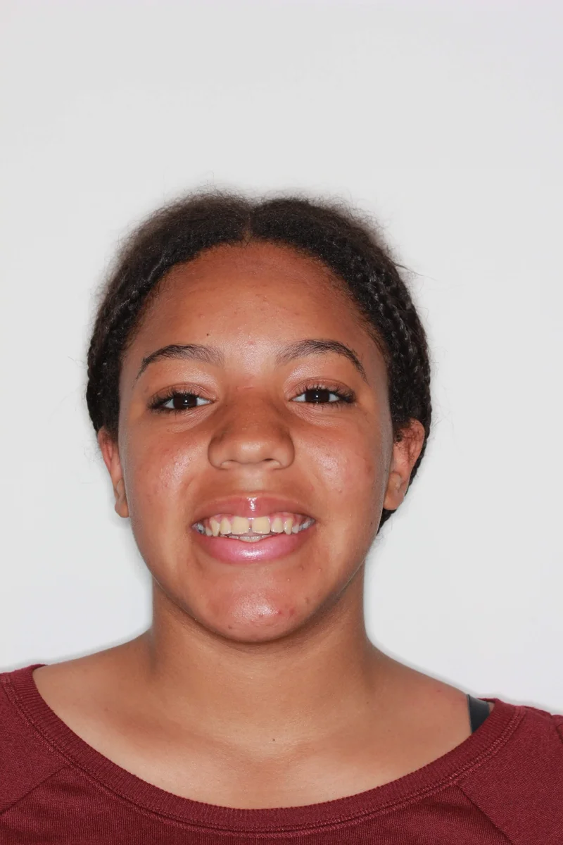 Facial Smiling - Before Treatment