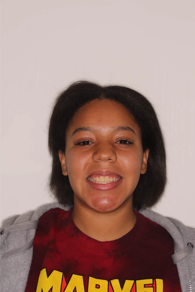 Facial Smiling - After Treatment