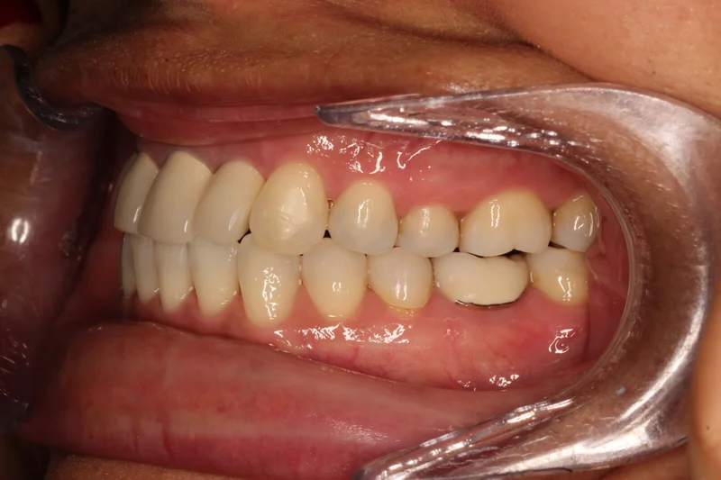 Left Buccal - After Treatment