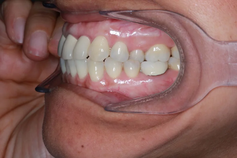 Left Buccal - Before Treatment
