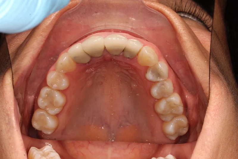 Upper Occlusal - After Treatment
