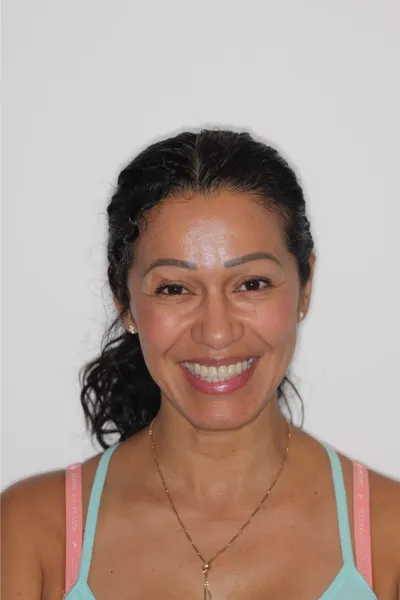 After Clear Braces treatment - Case 84719