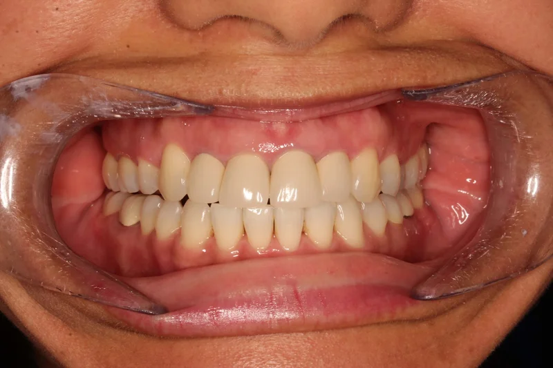 Center Bite - After Treatment
