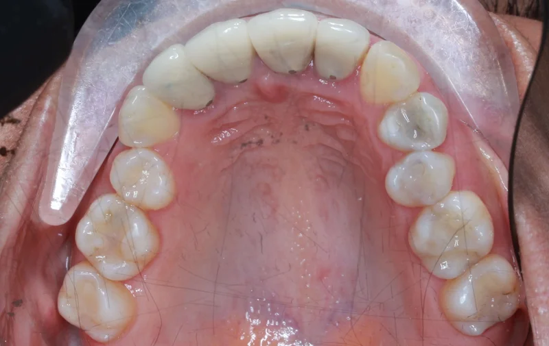 Upper Occlusal - Before Treatment
